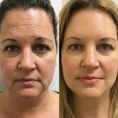 Mário Pereira — Firmeza facial results